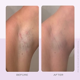 Ingrown Hair Pads - Batık tüyler için biyolojik olarak bozunabilen diskler x60